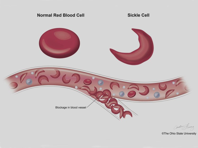 Decrease on the price of Sickle Cell medicine, stakeholders cry out